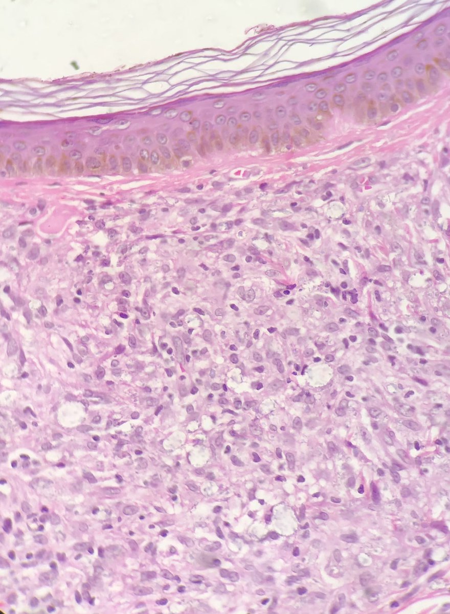 rqbittenc's tweet photo. Man, 37 yo, lesion in hand. That’s all the info we got. Tell me what you see or whats your diagnosis! Knock knock… who’s there? 👀 #knockknock #dermapath #skinpath #pathology #pathresidents #dermatology #path https://t.co/Q8SM9lieHi