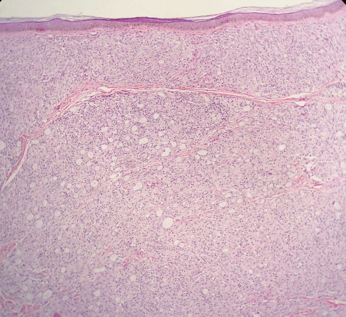 rqbittenc's tweet photo. Man, 37 yo, lesion in hand. That’s all the info we got. Tell me what you see or whats your diagnosis! Knock knock… who’s there? 👀 #knockknock #dermapath #skinpath #pathology #pathresidents #dermatology #path https://t.co/Q8SM9lieHi