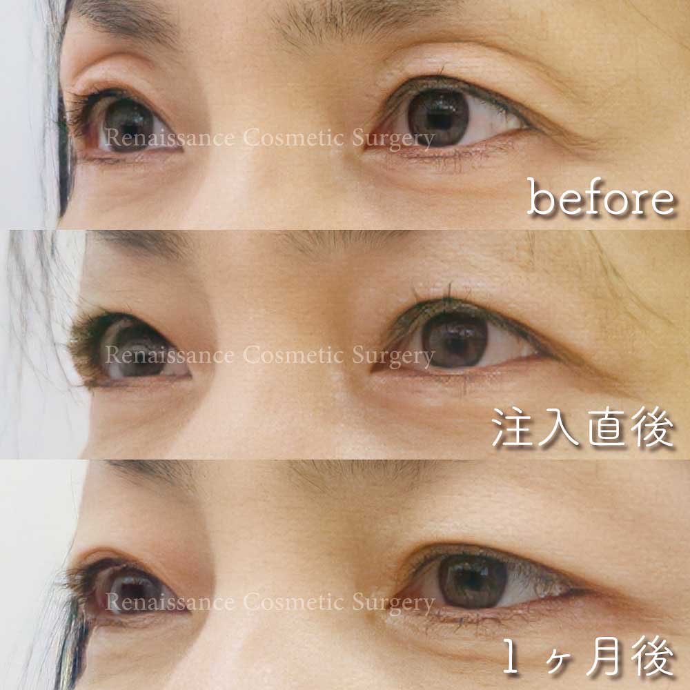 ルネッサンス美容外科医院 東京院 Ar Twitter Fgf組織再生療法 のご紹介です 今回の方は 年齢とともに進行したくぼみ目が原因で 目 の疲れや肩こりがひどくご相談に来られました くぼみ目が治ると元々あった奥二重のラインが綺麗に出て 仕上がりにとてもご満足