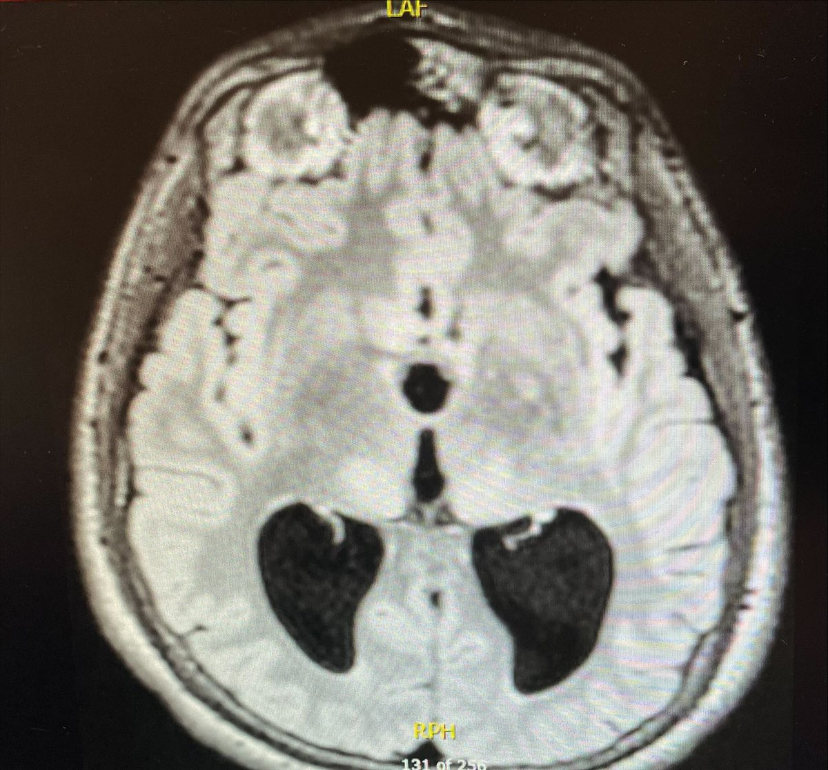 Fbabtain's tweet photo. This young man had focal seizure with impaired awareness.
What is your diagnosis?
A)FLE
B)TLE
C)BECTS
D)MELAS
💥The images will guide you!
#TwitterMD
#MedTwitter
#EEGtutorial
#Epilepsy
#Neurology
#Neuroscience
#فضفضة_طبيب https://t.co/21nH69070z