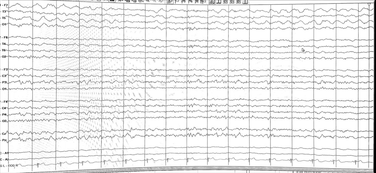 Fbabtain's tweet photo. This young man had focal seizure with impaired awareness.
What is your diagnosis?
A)FLE
B)TLE
C)BECTS
D)MELAS
💥The images will guide you!
#TwitterMD
#MedTwitter
#EEGtutorial
#Epilepsy
#Neurology
#Neuroscience
#فضفضة_طبيب https://t.co/21nH69070z