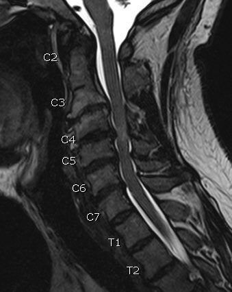 Corpectomy in patient with congenital anomalies.  Pre-op patient had clonus that just went on and on and on and on…