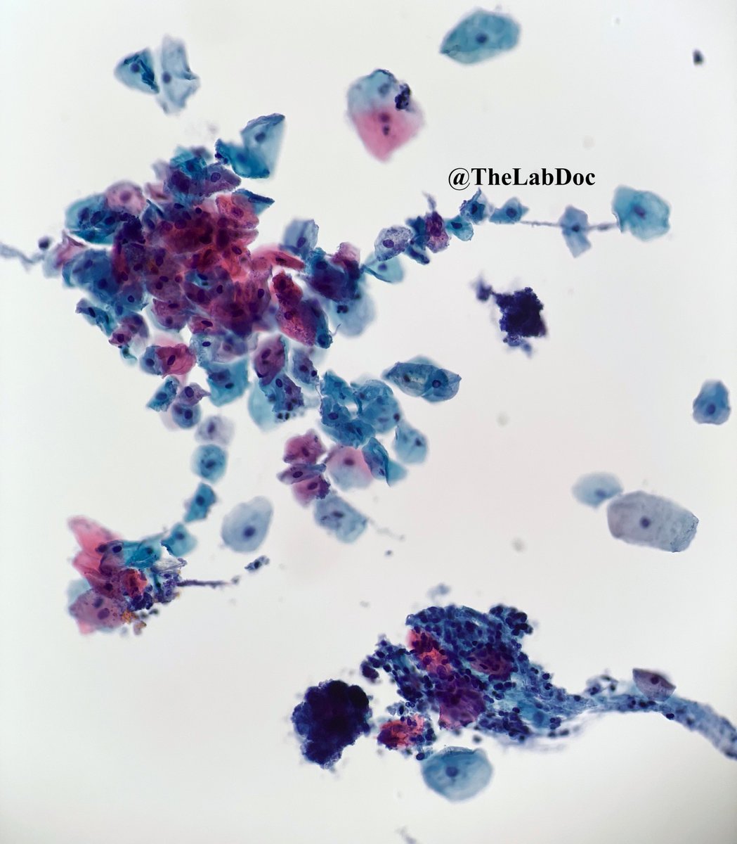 TheLabDoc's tweet photo. "Shish kebab" formation of reactive squamous epithelial cells on pseudohyphae of Candida spp. #PathTwitter #CytoPath #MicroRounds #MicroMedEd #IDTwitter #MedStudentTwitter https://t.co/1bQg7h6e5D