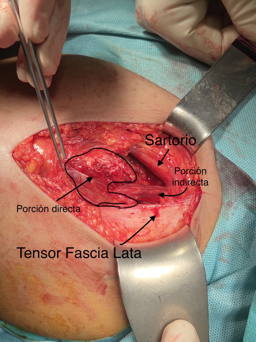 Realmente las dos porciones del recto anterior actúan independientes! Lesión del tendón directo con preservación del indirecto! //Both portions of rectus femoris were functionally independent. Direct tendon lesion with integrity of indirect! #surgery meets #anatomy #orthotwitter