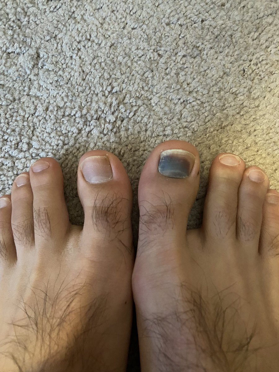 CripTuck's tweet photo. Hey @AaronRodgers12 from one COVID toe to another, get that #W tonight!!! #GoPackGo @packers #toevid #Packers cc @KurtBenkert https://t.co/s2SOps1yiC