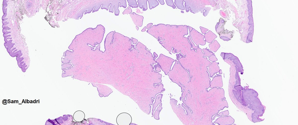 "Anal lesion in young woman"⚠️Benign phyllodes tumor⚠️journals.lww.com/ajsp/Fulltext/… #BreastPath #gynpath <a href="/MayoClinicPath/">Mayo Clinic Pathology</a>