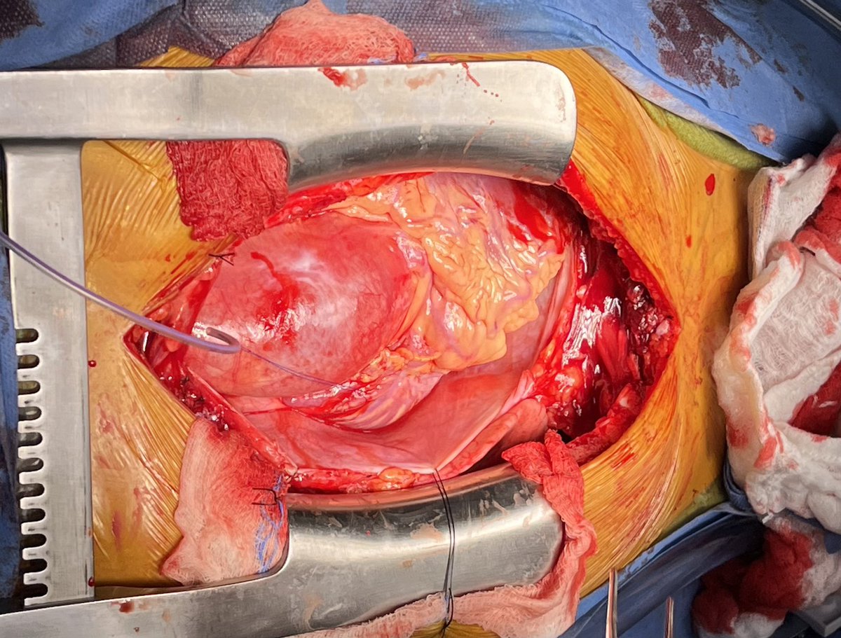 askdrgonzo's tweet photo. Recent 26 y/o with Marfan’s. Hemiarch and Bentall. https://t.co/Y3hesJPBVa