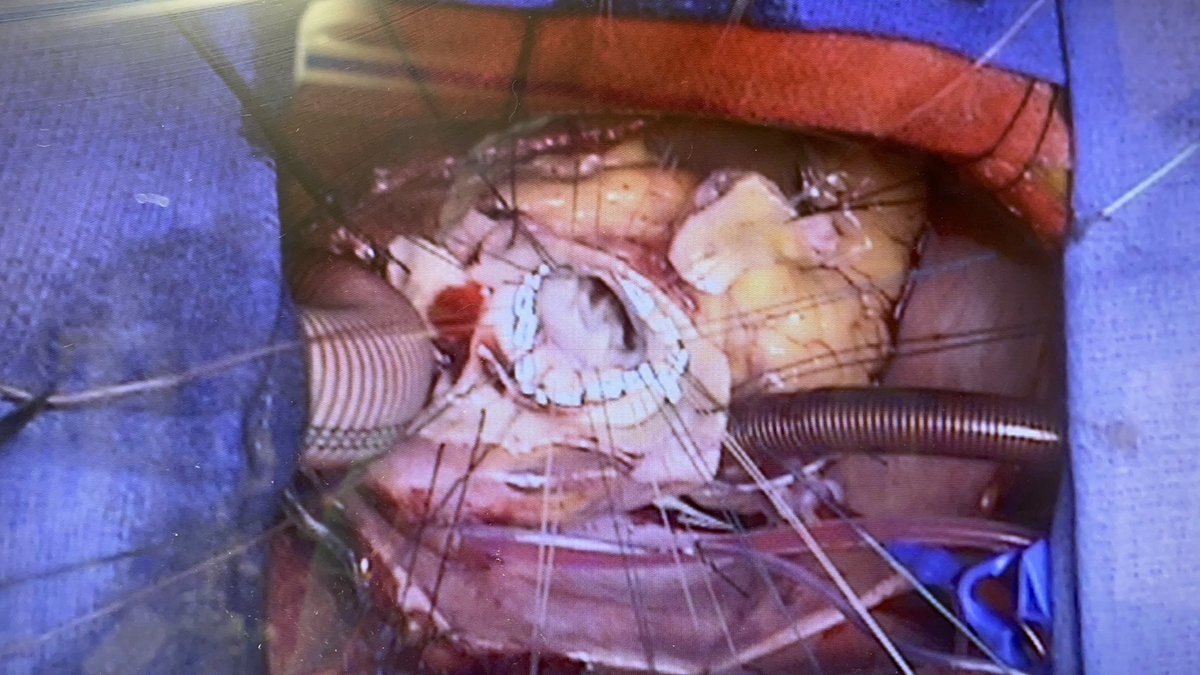 askdrgonzo's tweet photo. Recent 26 y/o with Marfan’s. Hemiarch and Bentall. https://t.co/Y3hesJPBVa