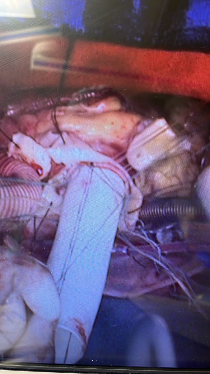 askdrgonzo's tweet photo. Recent 26 y/o with Marfan’s. Hemiarch and Bentall. https://t.co/Y3hesJPBVa
