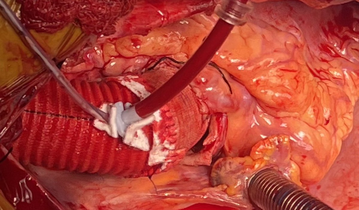 Recent 26 y/o with Marfan’s. Hemiarch and Bentall.