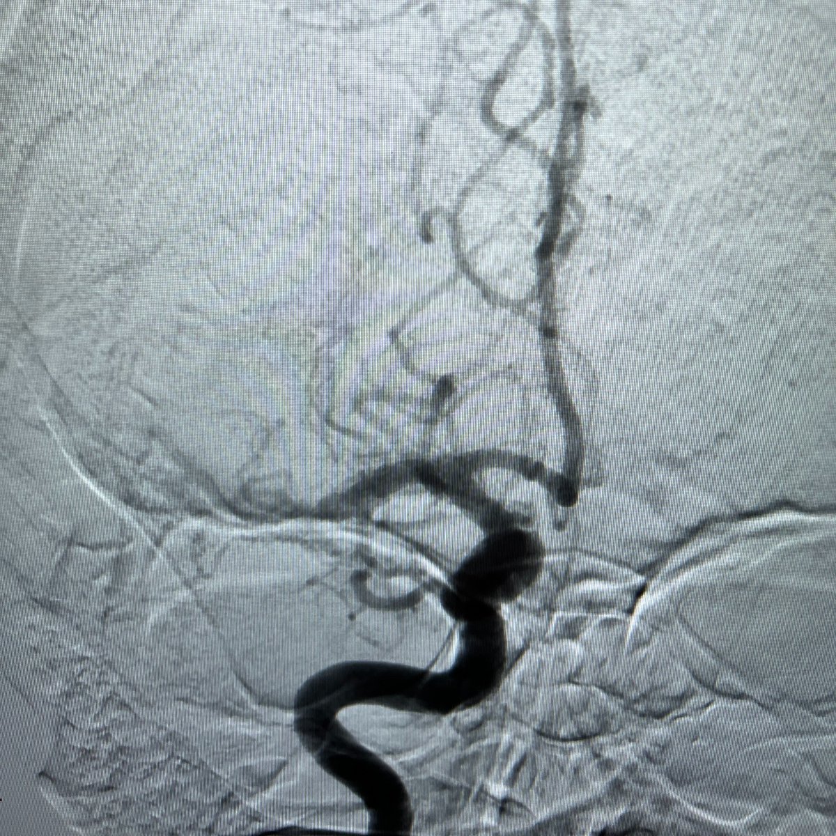 Rapid Medical (@rapid__medical) on Twitter photo "The ability to reduce the device before retrieval is one of my favorite features of the #TIGERTRIEVER”, said Dr. <a href="/MajidiShahram/">Shahram Majidi, MD</a> of <a href="/MountSinaiNYC/">Mount Sinai Health System</a>, following his recent treatment of a 28 year old M1 occlusion.
<a href="/svinsociety/">SVIN</a> <a href="/SNISinfo/">SNIS Info</a> <a href="/TheAJNR/">AJNR</a> <a href="/ASNRehab/">ASNR</a> <a href="/youngneuros/">AANS Early-to-mid Career Committee (#E2M)</a> <a href="/YoungNIR/">YoungNIR</a> "The ability to reduce the device before retrieval is one of my favorite features of the #TIGERTRIEVER”, said Dr. <a href="/MajidiShahram/">Shahram Majidi, MD</a> of <a href="/MountSinaiNYC/">Mount Sinai Health System</a>, following his recent treatment of a 28 year old M1 occlusion.
<a href="/svinsociety/">SVIN</a> <a href="/SNISinfo/">SNIS Info</a> <a href="/TheAJNR/">AJNR</a> <a href="/ASNRehab/">ASNR</a> <a href="/youngneuros/">AANS Early-to-mid Career Committee (#E2M)</a> <a href="/YoungNIR/">YoungNIR</a>