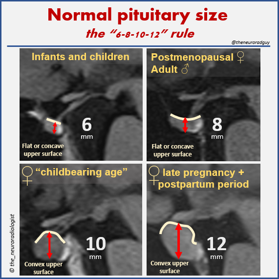 University Of Pennsylvania Neurology On Twitter pituitary Size university-of-pennsylvania-neurology-on-twitter-pituitary-size