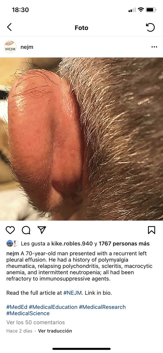 mig_yec's tweet photo. Una posible pregunta (realmente difícil por su especificidad, pero muy discriminativa) para el próximo MIR; lo pongo porque está muy de moda (reciente descubrimiento) y aparece en todos los congresos de Derma: SÍNDROME VEXAS (imagen reciente de NEJM) https://t.co/rjoKs8zngc