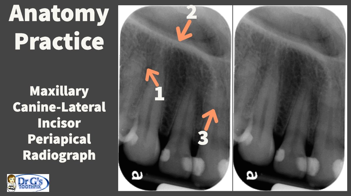 Anatomy Practice
Maxillary Canine-Lateral Incisor Periapical Radiograph
Answers coming later today