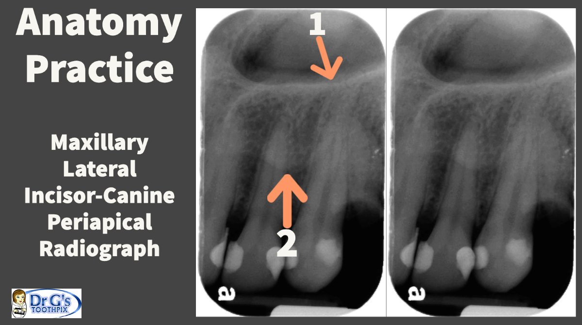 Answers for Anatomy Practice
1 = floor of the nasal cavity
2 = soft tissue of the nose