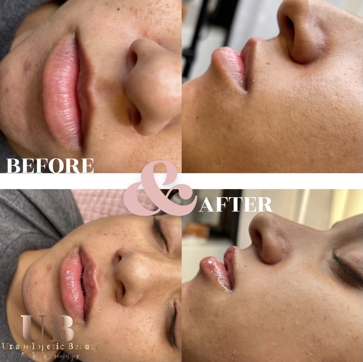 mel_leo05's tweet photo. Lips Augmentation💋
The active ingredient used,
hyaluronic acid,
rejuvenates and lifts the lip
area, as well as stimulating
collagen production.
Schedule your appointment now!
407-279-7623 https://t.co/5XAdRnxKzi
IG :@unapologeticbeautybymel https://t.co/3YSjFtRJmm