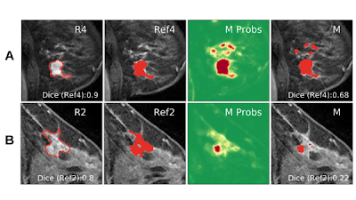 Radiology_AI's tweet photo. A 3D U-Net goes toe-to-toe with radiologists in segmenting breast cancers on MRI https://t.co/DKE8w2yzVN @andypotato @DrLizMorris @Dlilahh #BreastRad #DeepLearning #MachineLearning https://t.co/XEgPMR3cbb