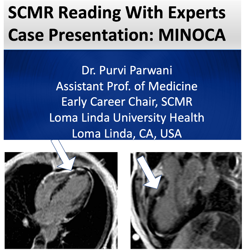 Great CMR case presentation by @purviparwani with co-discussant @nataliebello9 --> Case of recurrent MINOCA, diagnosed as small vessel vasculitis (EGPA) with eosinophilia, skin and eye involvement --> CMR with focal subendocardial LGE @AChoiHeart @SCMRorg @karen_ordovas