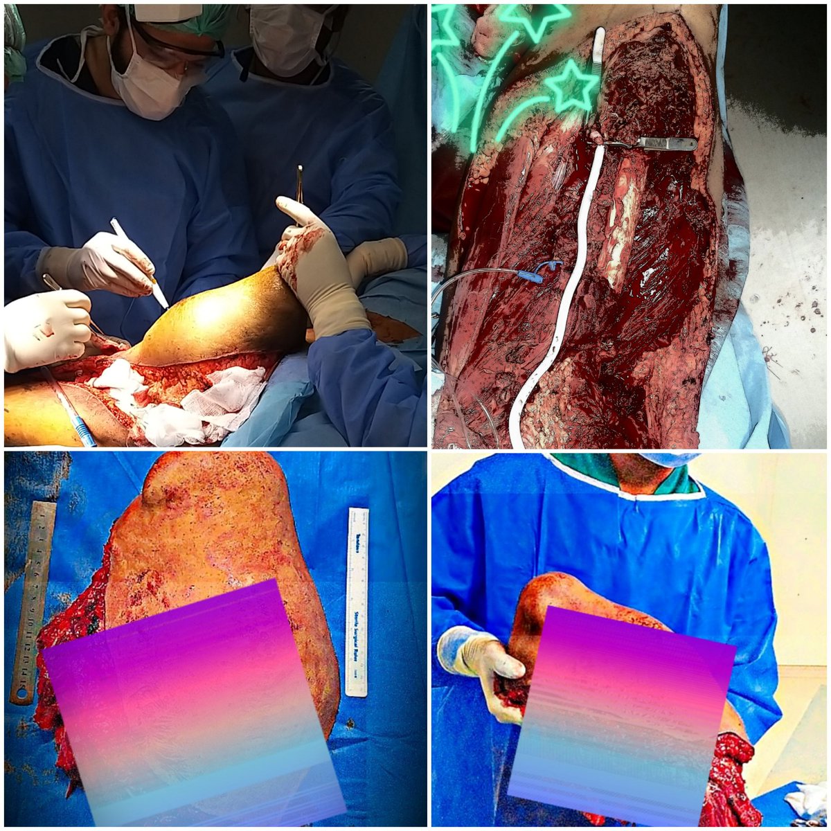 DrObadaHasan's tweet photo. Early referral of sarcoma patients to the specialized center is must. Challenging case operated twice outside for last 5 years (details below).
Thanks to @DrRahimBuxBhat2 
Cardivascular,plastic surgery and anesthesia teams @paqsjims.
Patient is cancer-free waiting for prosthesis. https://t.co/PhP7nieKTd