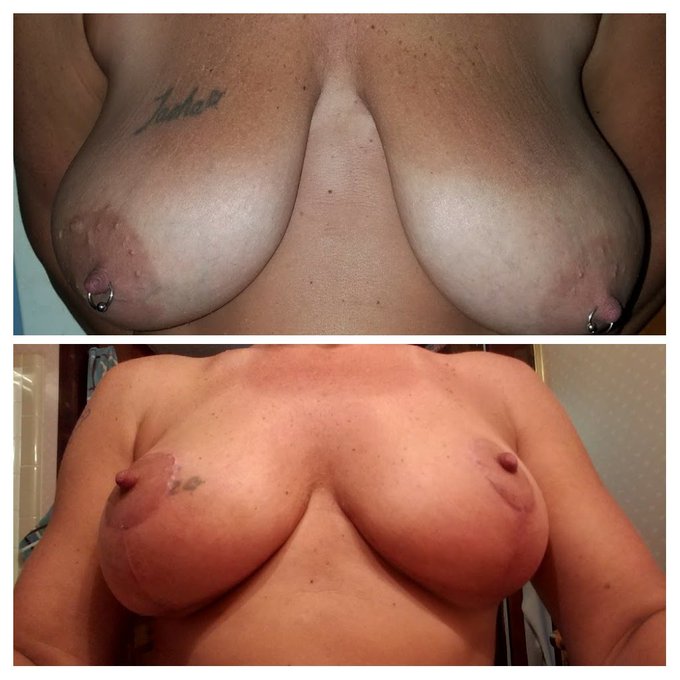 Before and after boob reduction. Which do you prefer? https://t.co/RF1u41eSiK