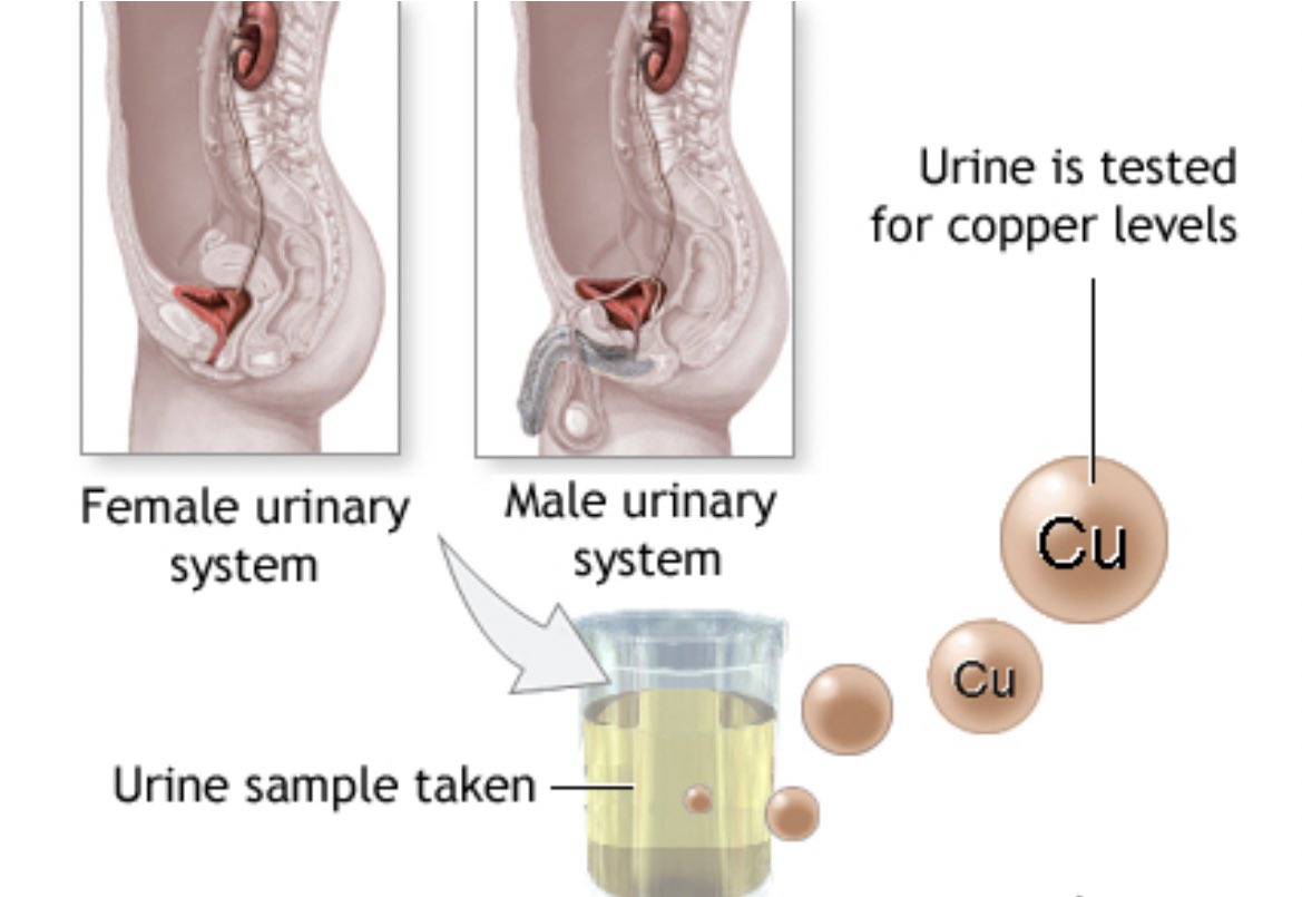 تحليل النحاس فى البول (urine copper) عنصر النحاس copper يوجد في الطعام