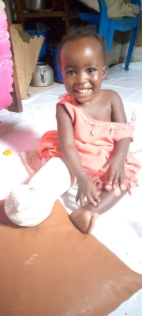 chilli_children's tweet photo. Two year-old, Chloe, came to the project with severe burns on her right leg, resulting in limited mobility. We were able to provide her with a surgery to release the contractures. And judging by her beautiful smile, she couldn't be more pleased about that! https://t.co/1hnPWYcqVM