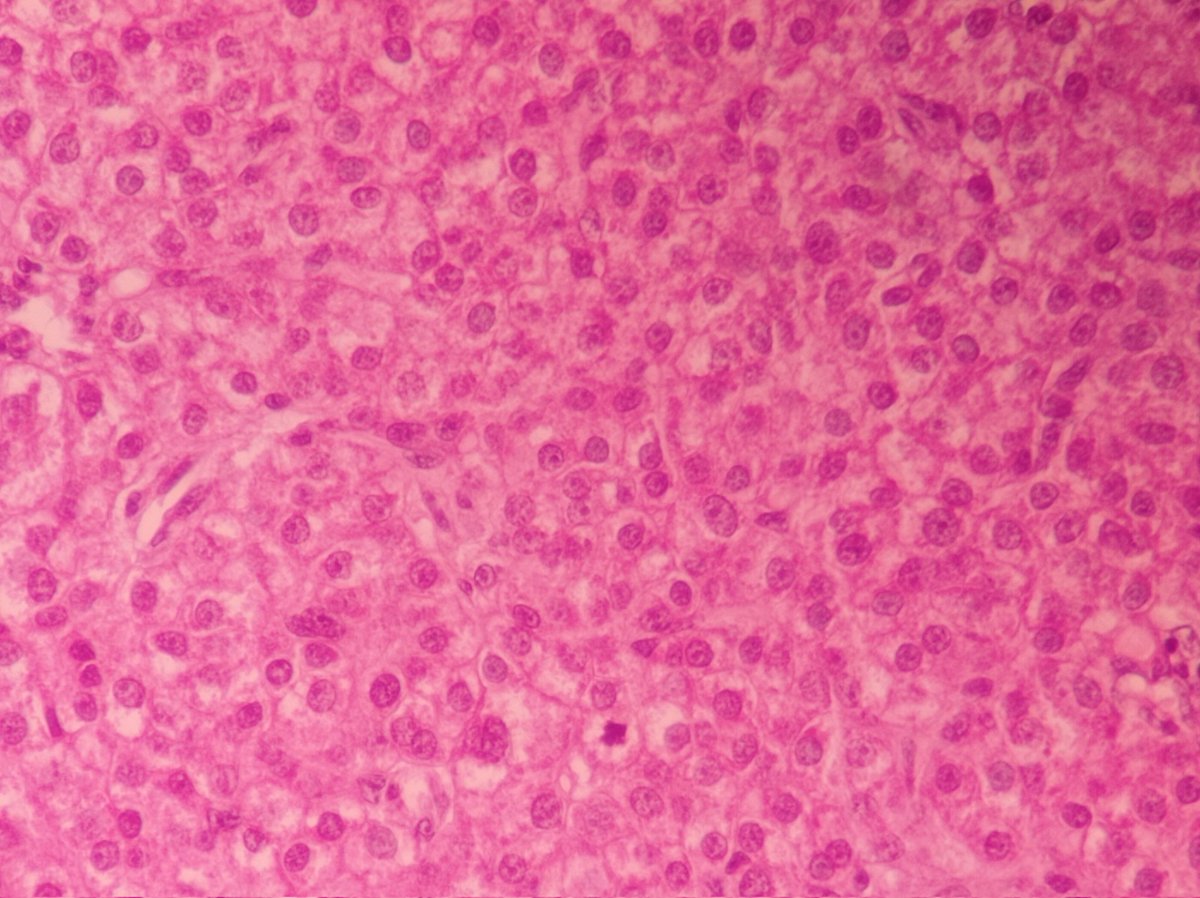 #Pathtweetplers I appreciate your thoughts here. Multiple white nodules  at right &amp; left hepatic lobules, 1 month evolution. #pathology #gipathology #GIpath
