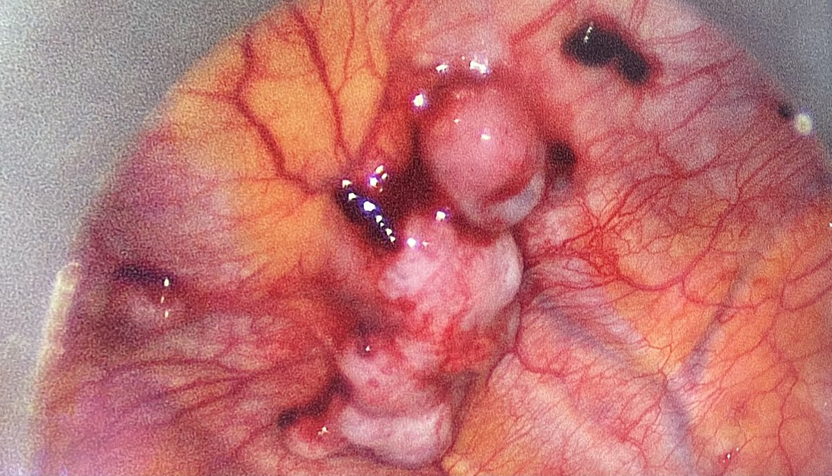 fmunizgonzalez's tweet photo. Implantes pleurales en paciente con antecedente de Carcinoma epidermoide resecado previamente. #neumologíaintervencionista #toracoscopia https://t.co/SM2j85MDRE
