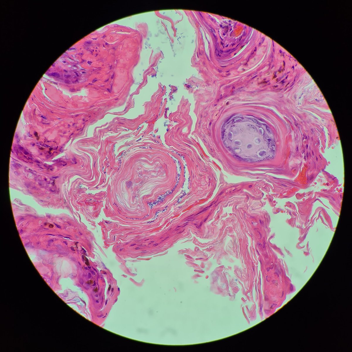 HibTheSlider's tweet photo. Demodex mites 🐛
Have a "commensal relationship with humans" 🤢
Usually aren't a problem unless they're seen too often in a specimen.
Linked to rosacea.
#pathresidents #beautyinbenign #pathtwitter #dermopath #grossthebenign https://t.co/R3YoYbmGTf