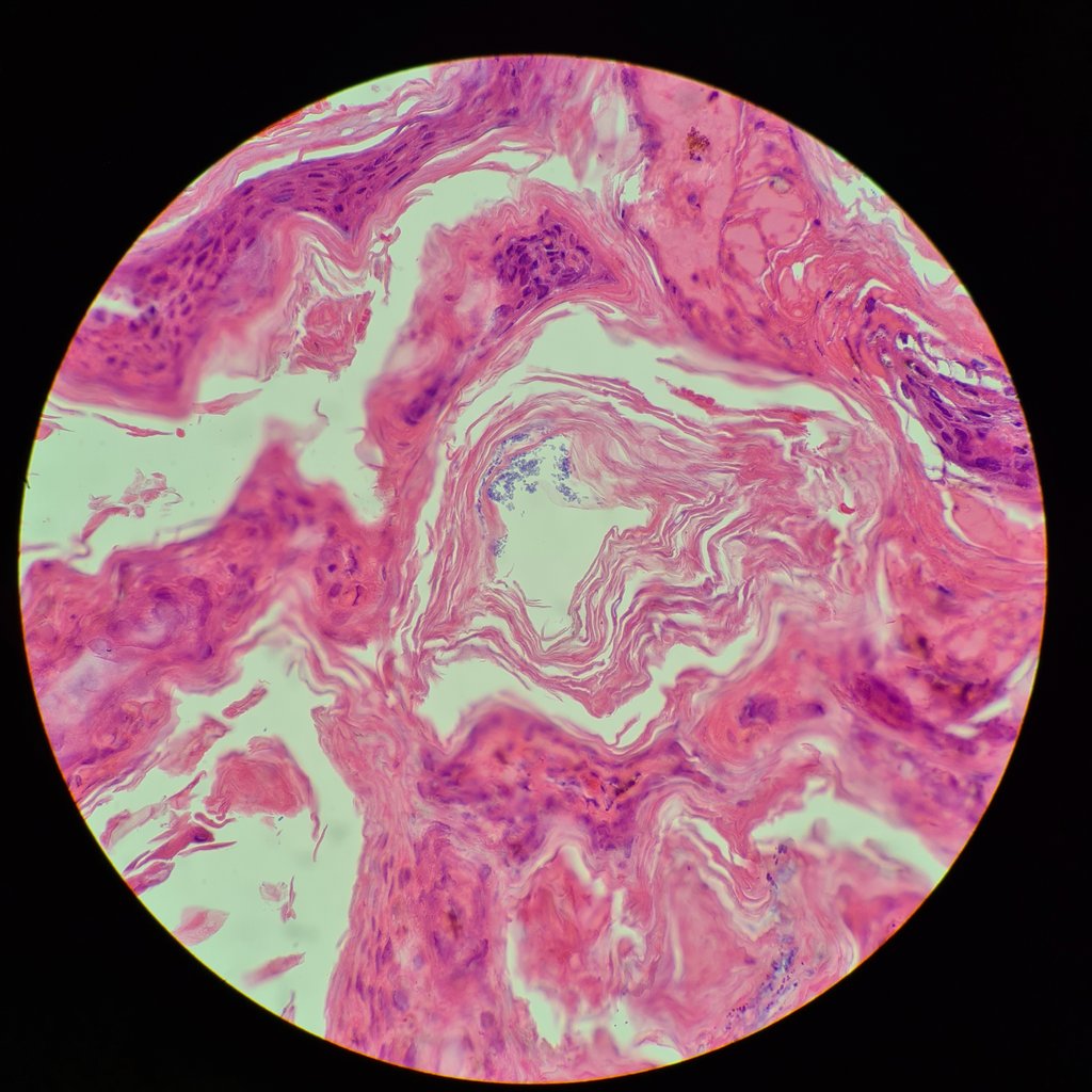 HibTheSlider's tweet photo. Demodex mites 🐛
Have a "commensal relationship with humans" 🤢
Usually aren't a problem unless they're seen too often in a specimen.
Linked to rosacea.
#pathresidents #beautyinbenign #pathtwitter #dermopath #grossthebenign https://t.co/R3YoYbmGTf