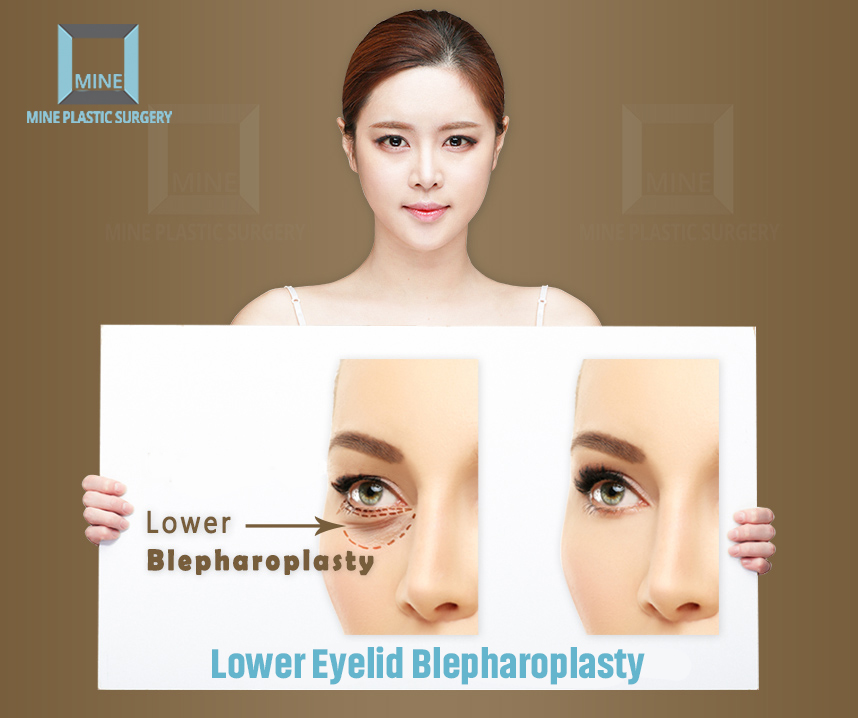 If you’re sick and tired of tired-looking eyes, Lower Eyelid Blepharoplasty could be the perfect treatment for you. It is a procedure to improve the sagging, baggy, or wrinkles of the undereye area.
#mineclinic #liposuction #beforeandafter  #surgery #beautifuleye #koreabeauty