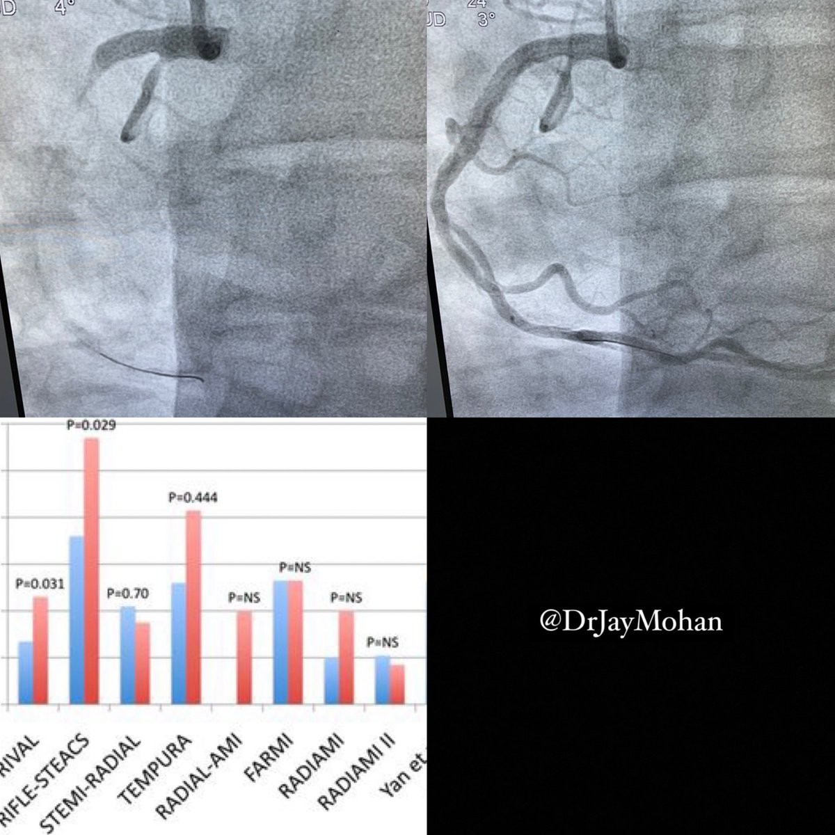 DrJayMohan's tweet photo. People have mocked #RadialFirst but idk how you can argue against the mortality benefit in #STEMI !! I just did  a great case where I encountered spasm and just used the 4F in 6F guide technique and proceeded radially. Patient did great! #Cardiotwitter for the win! #IVUS https://t.co/Igqcp4LeLX
