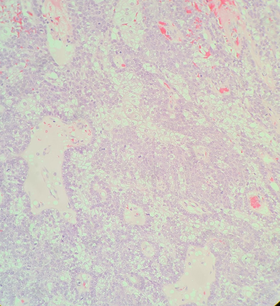 HibTheSlider's tweet photo. Middle-aged woman, neck lesion
Clinical details: ?BCC ?pyogenic granuloma
*stains in thread*
#pathresidents #beautyinbenign #pathtwitter #dermopath https://t.co/93ZzEqqdmR