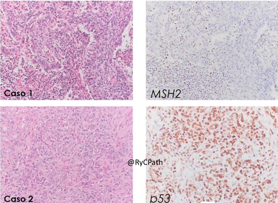 RyCPatologia's tweet photo. Póster con defensa de @EsthM92 - Caracterización molecular de los distintos subtipos histológicos de carcinomas de endometrio #GyPath https://t.co/UJy02hbuvJ