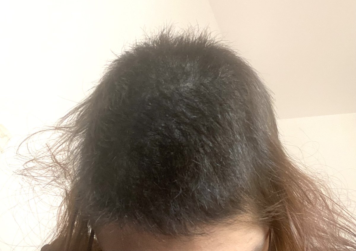 depressedwhiny's tweet photo. A bit of progress after the photo I took at the end of December. 
I’m very afraid cause exams are approaching, wish me luck and strength 🥺
 #trichotillomania #trichstop #stoptrich #hairpulling https://t.co/Tx4BYEORrC