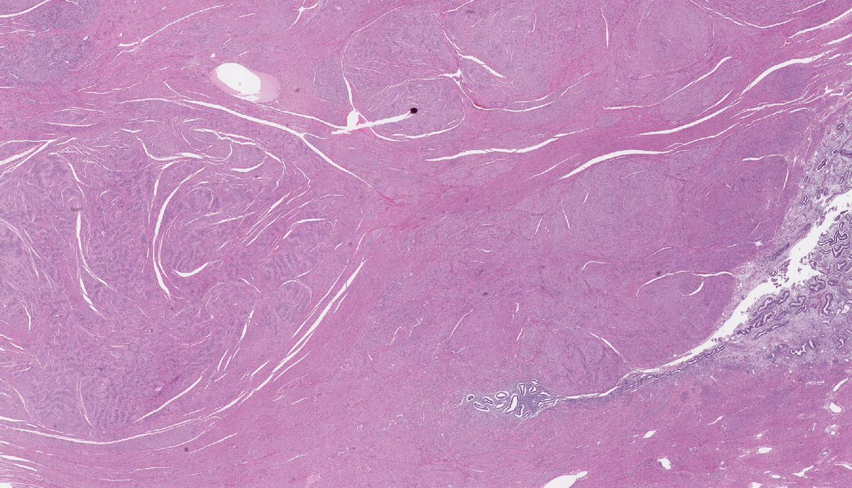 Jerad Gardner, MD on Twitter "RT histiocytosisX LEIOMYOMA. IHC h