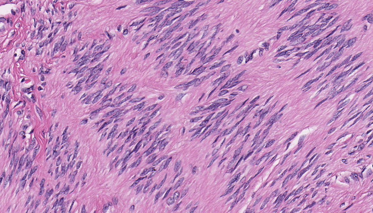 Jerad Gardner, MD on Twitter "RT histiocytosisX LEIOMYOMA. IHC h