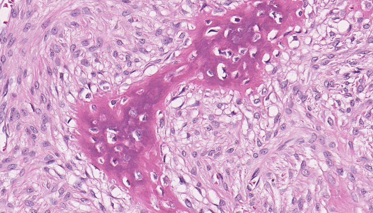 FIBROUS DYSPLASIA. NB: spindle-stellate cells;
eosinophilic cytoplasm; monomorphic ovoid nuclei; irregularly-shaped woven bone trabeculae with incomplete osteoblastic rimming.