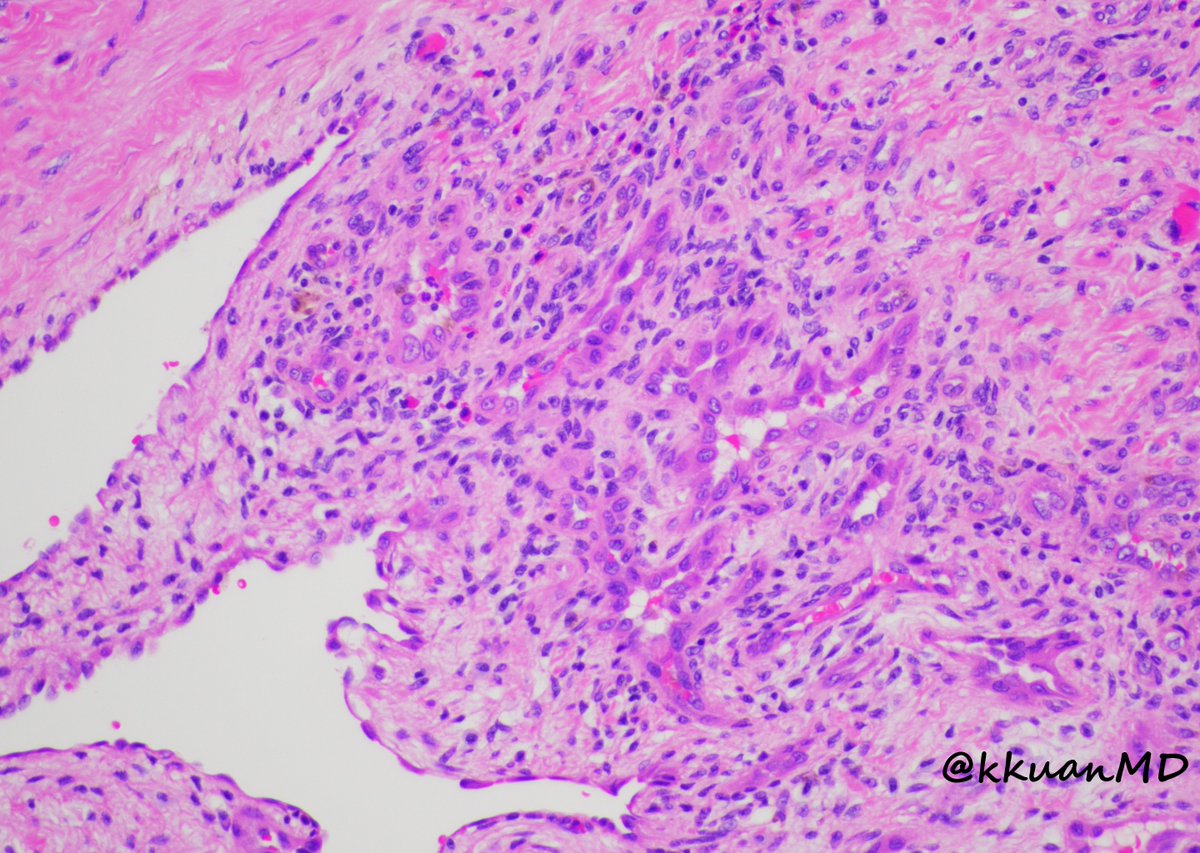 24yo F, 2cm wrist lesion. #pathology #pathtwitter #BSTpath #pathboards <a href="/EinsteinPath/">Einstein Montefiore Pathology</a> @histiocytosisX <a href="/JLHornick/">Jason L. Hornick, M.D., Ph.D.</a> <a href="/TristanRutland7/">Tristan Rutland MBBS FRCPA IFCAP</a> <a href="/Dr_Brian_Cox/">Brian Cox, MD, MAS</a> <a href="/DrVish/">Vish Killari MD MPH</a> <a href="/ariella8/">Celina Stayerman MD</a> <a href="/ALBoothMD/">Adam L. Booth, MD</a> <a href="/JMGardnerMD/">Jerad Gardner, MD</a> <a href="/DrGeeONE/">Olaleke Folaranmi</a>
