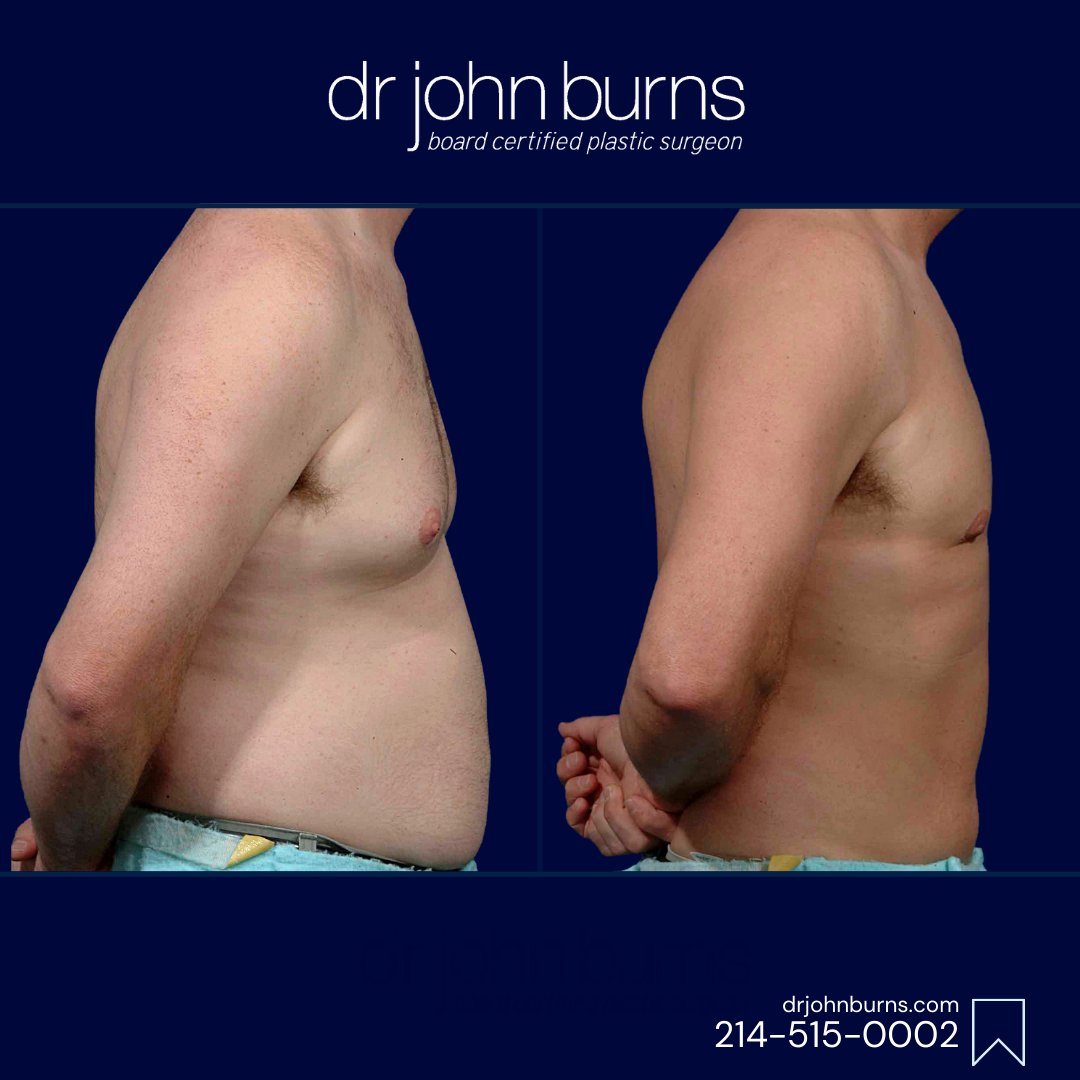 drjohnburns's tweet photo. This patient couldn't kick his dad bod with diet and exercise, so I used VASER ultrasound lipo because it provides the most complete removal of unwanted fat, allowing me to etch out his ab muscles.
#maleliposuction #dallasplasticsurgeon #malelipo https://t.co/Y3j26qm5ws