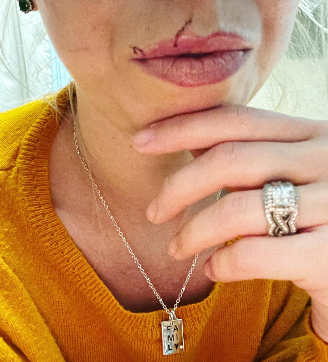 daniellebanks08's tweet photo. 🐈⬛ #catscratchfever 😞 #damncat - she’s going blind from old age and is 18 years old. I’m healed up now though as good as the scar marks are gonna get but went all the way through to the inside of my lip. Unsure about getting my lip liner tattoo’d on now with scars. #meow #darnet https://t.co/3dhSIV8kAE
