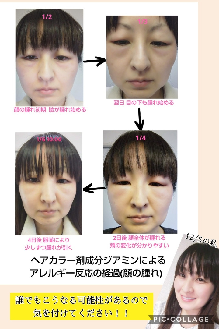 echoko5's tweet image. 私は去年、ヘアカラーで強いアレルギー反応が出ました。顔が腫れて頭皮から黄色い汁が汗のように流れ出し、全身に発疹が出ました。染めてから10日も経っていたので、まさかカラー剤だとは分からず…
顔の腫れは何か原因があると思います。
ご参考にしていただけたら幸いです。
お大事にしてください。