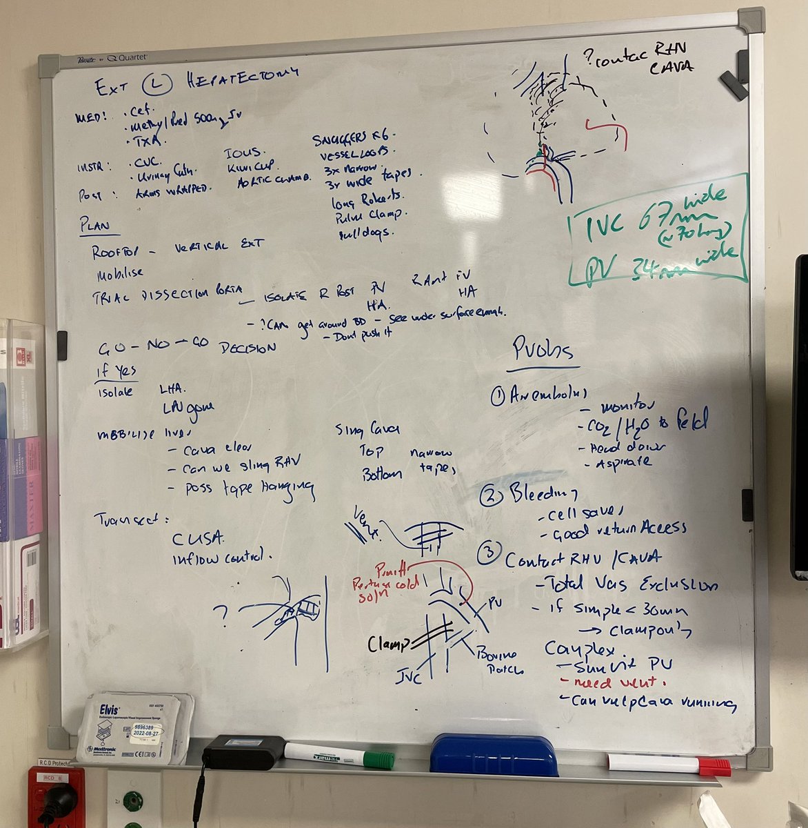 sharonmjay's tweet image. Planned decision making in the #OperatingRoom. Surgeon leading a multi facet team in a complex #HPB case. Plans drawn on whiteboard in team brief at start of day. Love the decision making “Go-No-Go=Decision” #ReduceErrors #HumanFactors #GoNoGo #Clarity #teamworkmakesthedreamwork