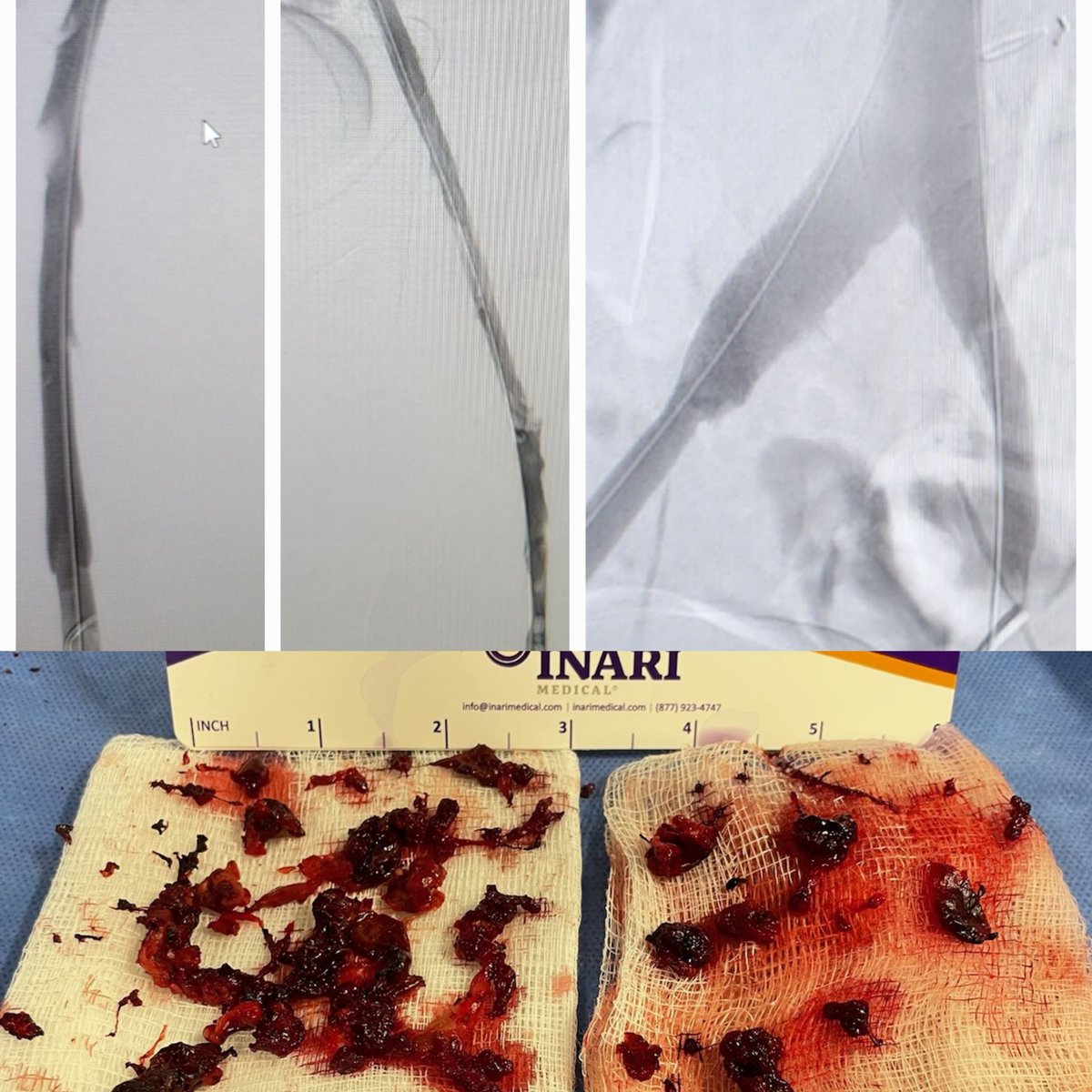 Temple Radiology (@templerads) on Twitter photo Patient with caval/iliac vein thrombosis. TPA lysis, Inari Clottriever thrombectomy, balloon maceration and venoplasty, and finally iliac vein stent. Whew! Tough case, but beautiful result. Great job <a href="/spratipat/">Pratik Patel</a> <a href="/joepanaro/">Joe Panaro, MD</a> <a href="/theIRbryan/">Bryan Z. Hamade, MD</a>! <a href="/InariMedical/">Inari, now part of Stryker</a> <a href="/TempleRadRes/">Temple Radiology Residents</a> <a href="/SIR_ECS/">SIR ECS</a> <a href="/SIRRFS/">SIR RFS</a> Patient with caval/iliac vein thrombosis. TPA lysis, Inari Clottriever thrombectomy, balloon maceration and venoplasty, and finally iliac vein stent. Whew! Tough case, but beautiful result. Great job <a href="/spratipat/">Pratik Patel</a> <a href="/joepanaro/">Joe Panaro, MD</a> <a href="/theIRbryan/">Bryan Z. Hamade, MD</a>! <a href="/InariMedical/">Inari, now part of Stryker</a> <a href="/TempleRadRes/">Temple Radiology Residents</a> <a href="/SIR_ECS/">SIR ECS</a> <a href="/SIRRFS/">SIR RFS</a>