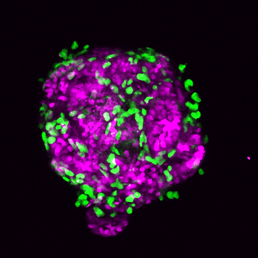 Barts Cancer Institute (Queen Mary) (@qmbci) on Twitter photo Researchers from BCI <a href="/QMULBartsTheLon/">Barts and The London, Queen Mary</a>, led by Dr Angus Cameron, have found a way to modulate the invasive behaviour of #PancreaticCancer by targeting a non-cancerous cell type called fibroblasts ⬇️ bartscancer.london/publications/2… Researchers from BCI <a href="/QMULBartsTheLon/">Barts and The London, Queen Mary</a>, led by Dr Angus Cameron, have found a way to modulate the invasive behaviour of #PancreaticCancer by targeting a non-cancerous cell type called fibroblasts ⬇️ bartscancer.london/publications/2…