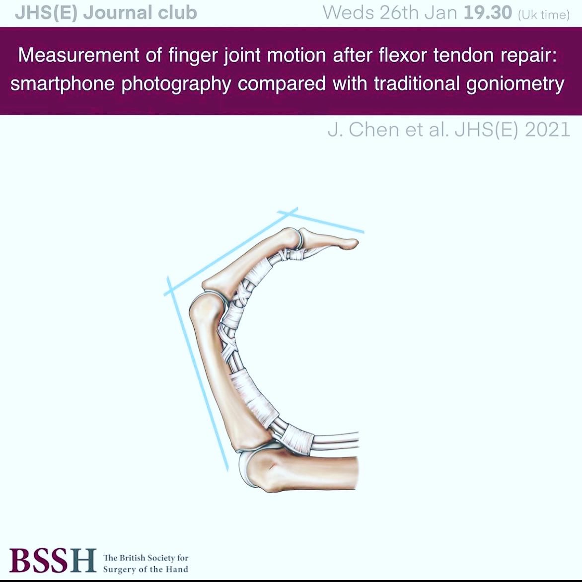 zafnaqui's tweet photo. Join @JHSEur tonight for some lively debate about controversies in flexor tendon repair and rehabilitation #handsurgery #flexors @FESSHEurope @BSSHand https://t.co/OpGLjETskB