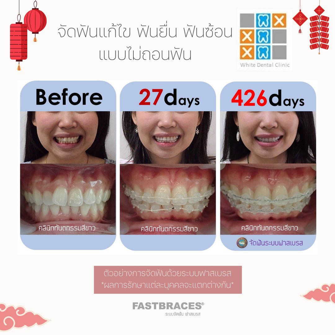 FastbracesAsia's tweet photo. โดย : คลินิกทันตกรรมสีขาว 🥰
สอบถามราคาและโปรโมชั่น https://t.co/WkwkaU935D
.
.
#แบร็กเก็ตสามเหลี่ยม #จัดฟัน 
#จัดฟันเร็ว #เจ็บน้อย #เหงือกไม่ร่น #อยากจัดฟัน #จัดฟันที่ดีที่สุด #จัดฟันที่ไหนดี #ข้อมูลจัดฟัน 
#ไม่ถอนฟัน #ฟาสเบรส #fastbraces  #จัดฟันลาดพร้าว #ด้อมเขียวด้อมใจ https://t.co/Hgm0fQNYTI