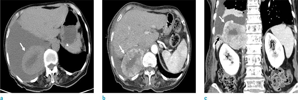 2021 DEC 25(4) - 12. Case Report

'MRI Findings of a Malignant Solitary Fibrous Tumor of the Diaphragmatic Pleura: a Case Report'
by Jeong Kyeom Kim, ...

Full text: doi.org/10.13104/imri.…