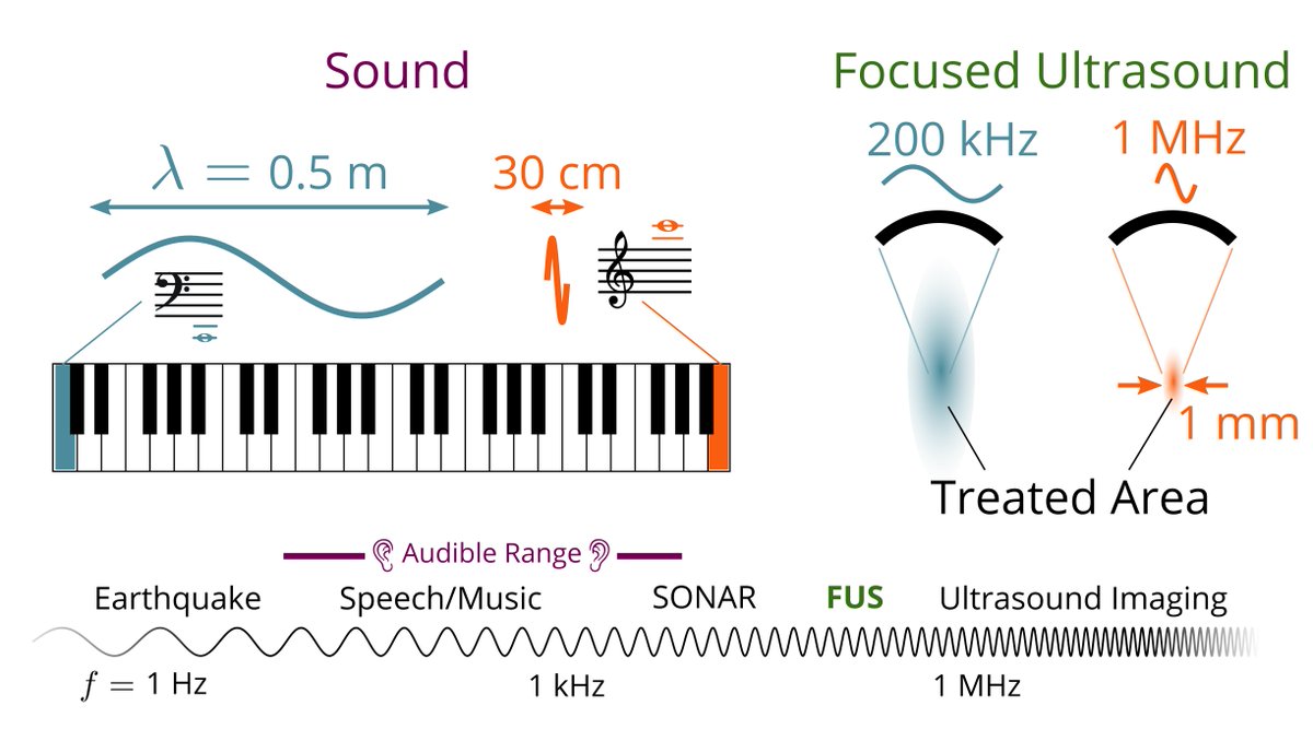 acousticsorg's tweet photo. Focused ultrasound (FUS) creates small regions of high heat or forces to burn or manipulate the tissue. This is especially important for brain diseases, where surgery is particularly challenging. https://t.co/6t3fXoqRFR

#LayLanguage https://t.co/PsUlOy9vqL