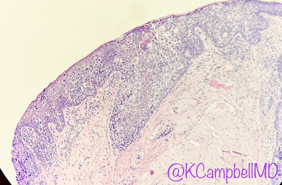 KCampbellMD's tweet photo. Older patient, bx from eyelid. Clinical impression: r/o SCC. What is your ddx? 👁🧠 #dermpath #ocularpath #optho https://t.co/13trNcxEn6